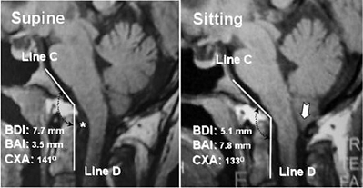 Notice Cerebellar Tonsillar Ectopia over looked when supine Notice Cerebellar Tonsillar Ectopia over looked when supine