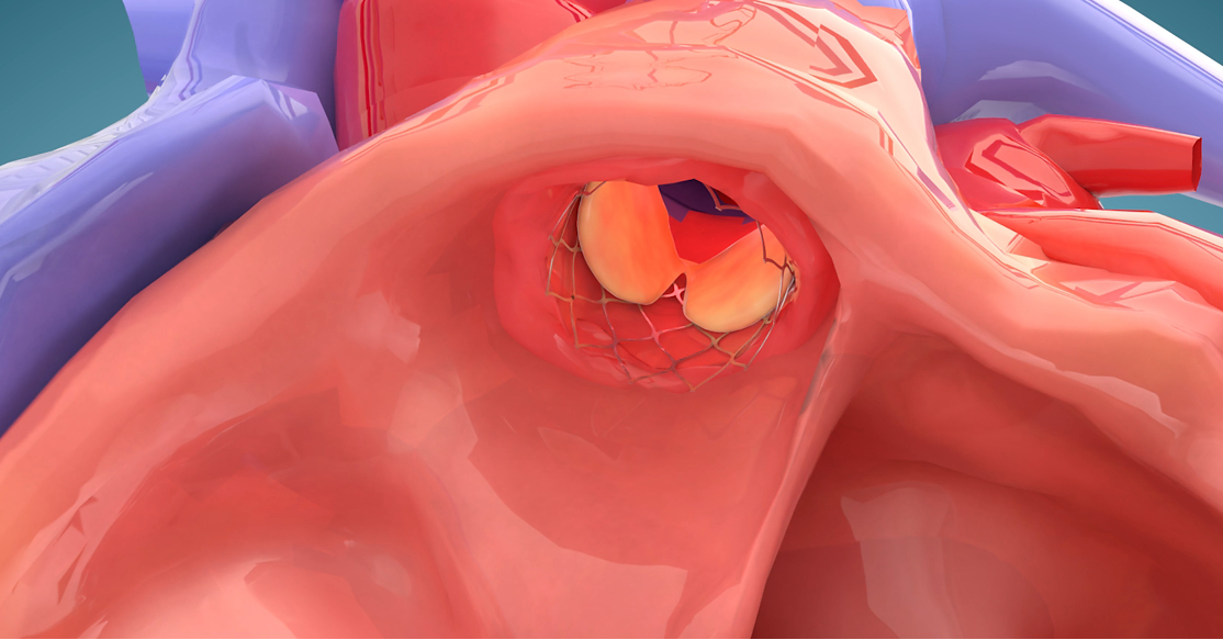 GrOwnValve Achieves Primary Safety Endpoint in First-in-Human Heart Valve Study