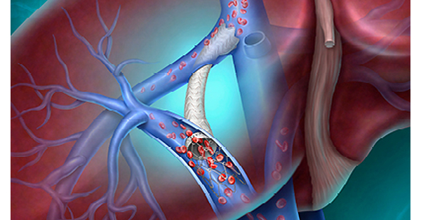 BD Advances Portal Hypertension Care in the U.S. with Support for More Personalized Treatment Options