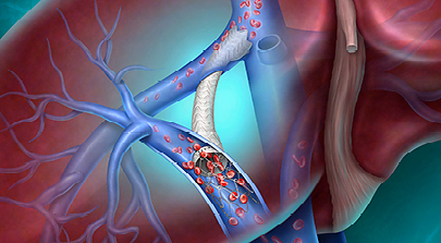 The Liverty™ TIPS Stent Graft, now commercially available in the U.S., is designed to give physicians greater flexibility to tailor treatment for patients with complications of portal hypertension. The Liverty™ TIPS Stent Graft, now commercially available in the U.S., is designed to give physicians greater flexibility to tailor treatment for patients with complications of portal hypertension.