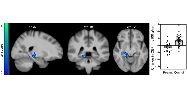 New Research Finds Daily Peanut Consumption Benefits Brain's Response to Insulin in Memory Related Regions