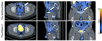 Figure 2. 64Cu-SAR-bisPSMA and 68Ga-PSMA-11 PET/CT images of a participant demonstrating difference in pelvic lymph node detection. One pelvic lymph node (6 mm in size) in the left pelvic region was detected by both readers on 64Cu-SAR-bisPSMA scan (arrow; top images) but not on the 68Ga-PSMA-11 scan (bottom images). This lesion was later confirmed as prostate cancer via histopathology.