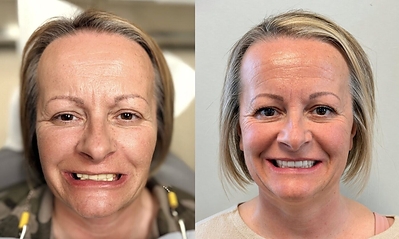 Dominika before (left) and after (right) upper and lower full-arch implants with pterygoid implants. Photos unretouched apart from cropping.