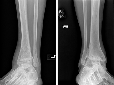 Stone Research Foundation Publishes Promising Evidence for a Missing Solution in Ankle Arthritis Care