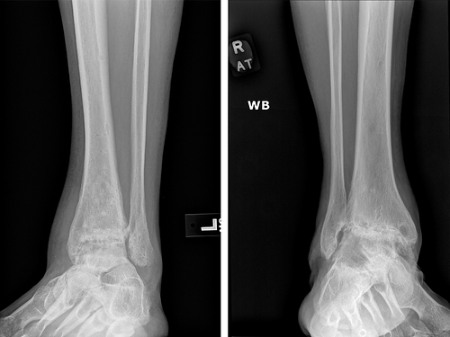 X-rays showing severe ankle arthritis and joint-space loss, the type of cartilage deterioration addressed by Stone Research Foundation’s ArtCart research. X-rays showing severe ankle arthritis and joint-space loss, the type of cartilage deterioration addressed by Stone Research Foundation’s ArtCart research.