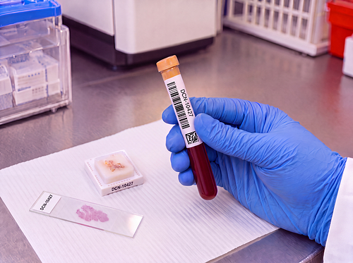 For developers of liquid biopsy assays, including multi-cancer early detection (MCED) and measurable residual disease (MRD) tests, specimens must reflect the disease stages and patient populations under study. The acquisition broadens DCN Dx's sourcing options for oncology, neurology, and autoimmune disease research. For developers of liquid biopsy assays, including multi-cancer early detection (MCED) and measurable residual disease (MRD) tests, specimens must reflect the disease stages and patient populations under study. The acquisition broadens DCN Dx's sourcing options for oncology, neurology, and autoimmune disease research.